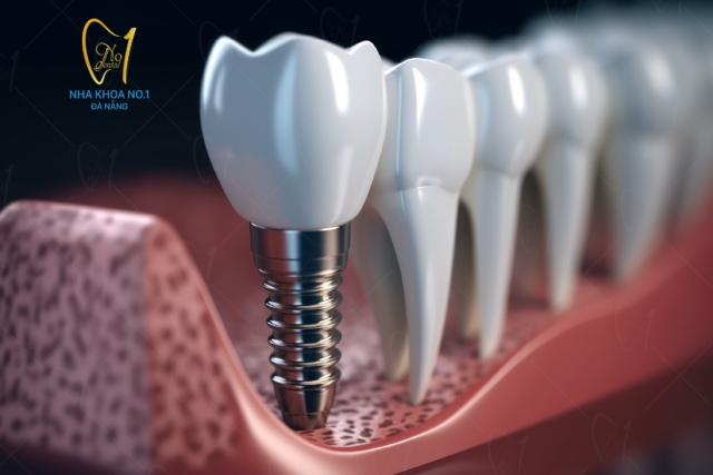 Implant Thụy Sỹ