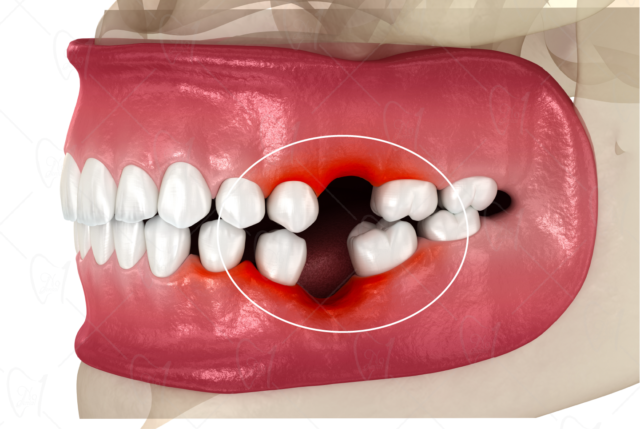 Răng bị dịch chuyển sai lệch vị trí gây đau nhứt do mất răng lâu ngày