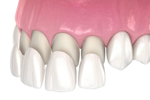 Dán Veneer không cần mài răng là ưu điểm nhận được rất nhiều sự chú ý