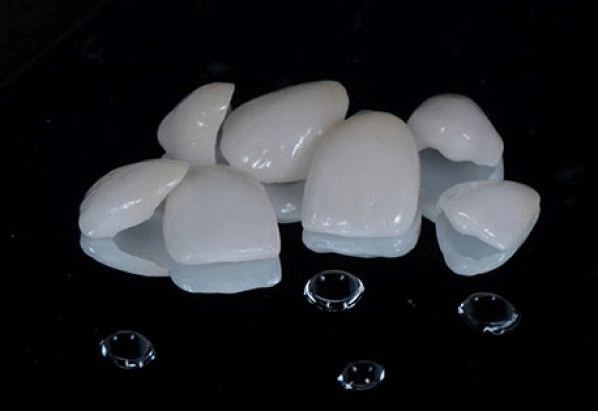 Ưu điểm của dán sứ Veneer