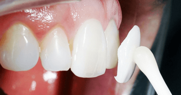 Dán sứ Veneer là giải pháp phục hồi răng phổ biến
