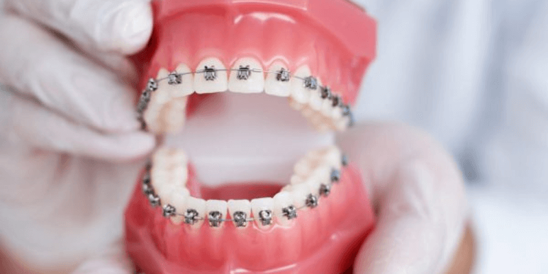 Lợi ích tuyệt vời của niềng răng