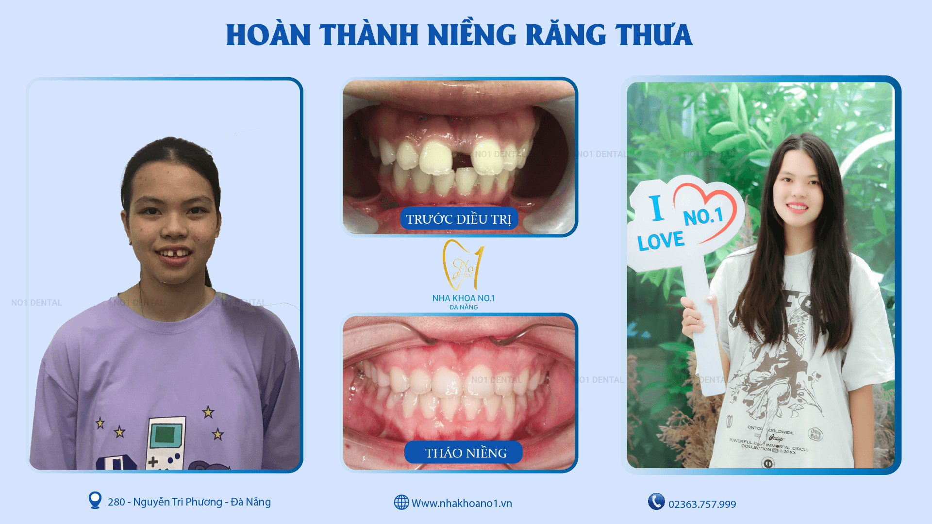 Tháo niềng răng thưa