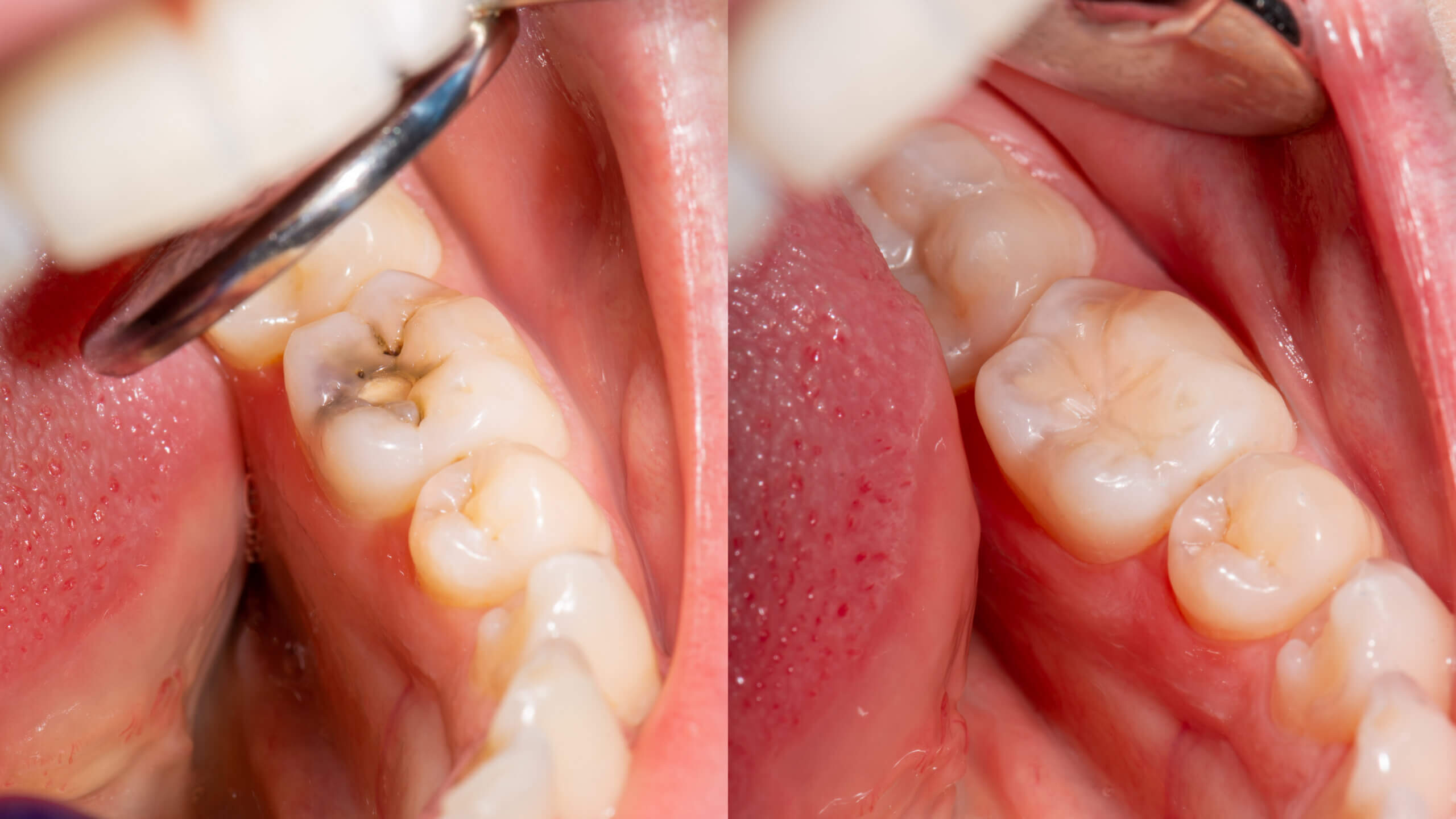 Trám răng thẩm mỹ, cải thiện ăn nhai