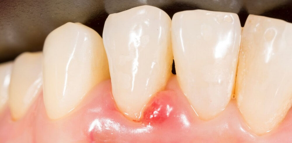 Áp xe răng hình thành những túi mủ quanh chân răng