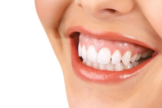 Hở lợi khiến nụ cười kém tự tin