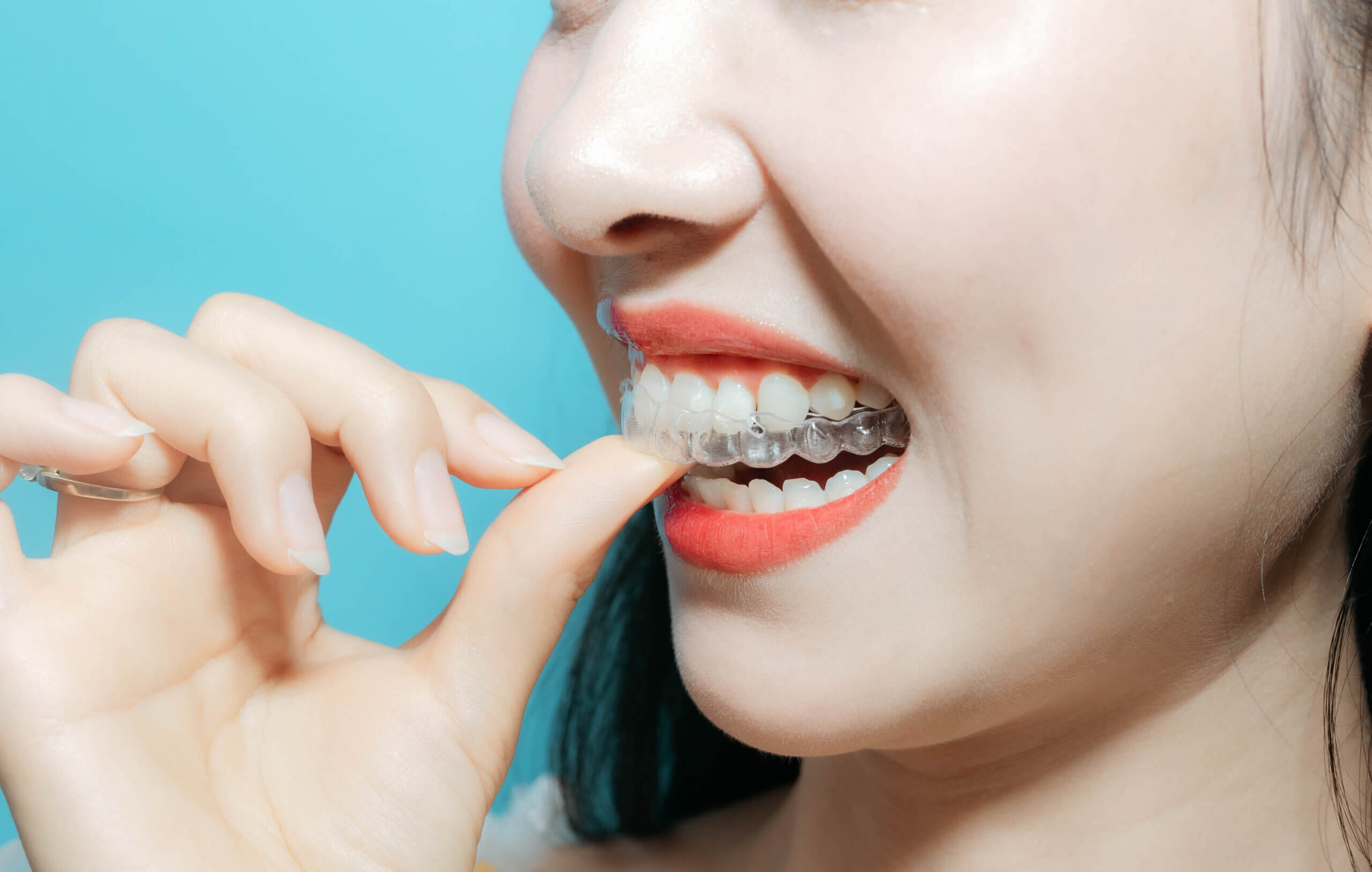 nieng-rang-trong-suot-2 Niềng Invisalign