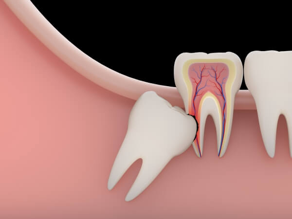 Các trường hợp nên nhổ răng khôn