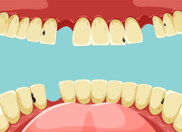Mọi người dễ chủ quan bởi sâu răng mức độ 1