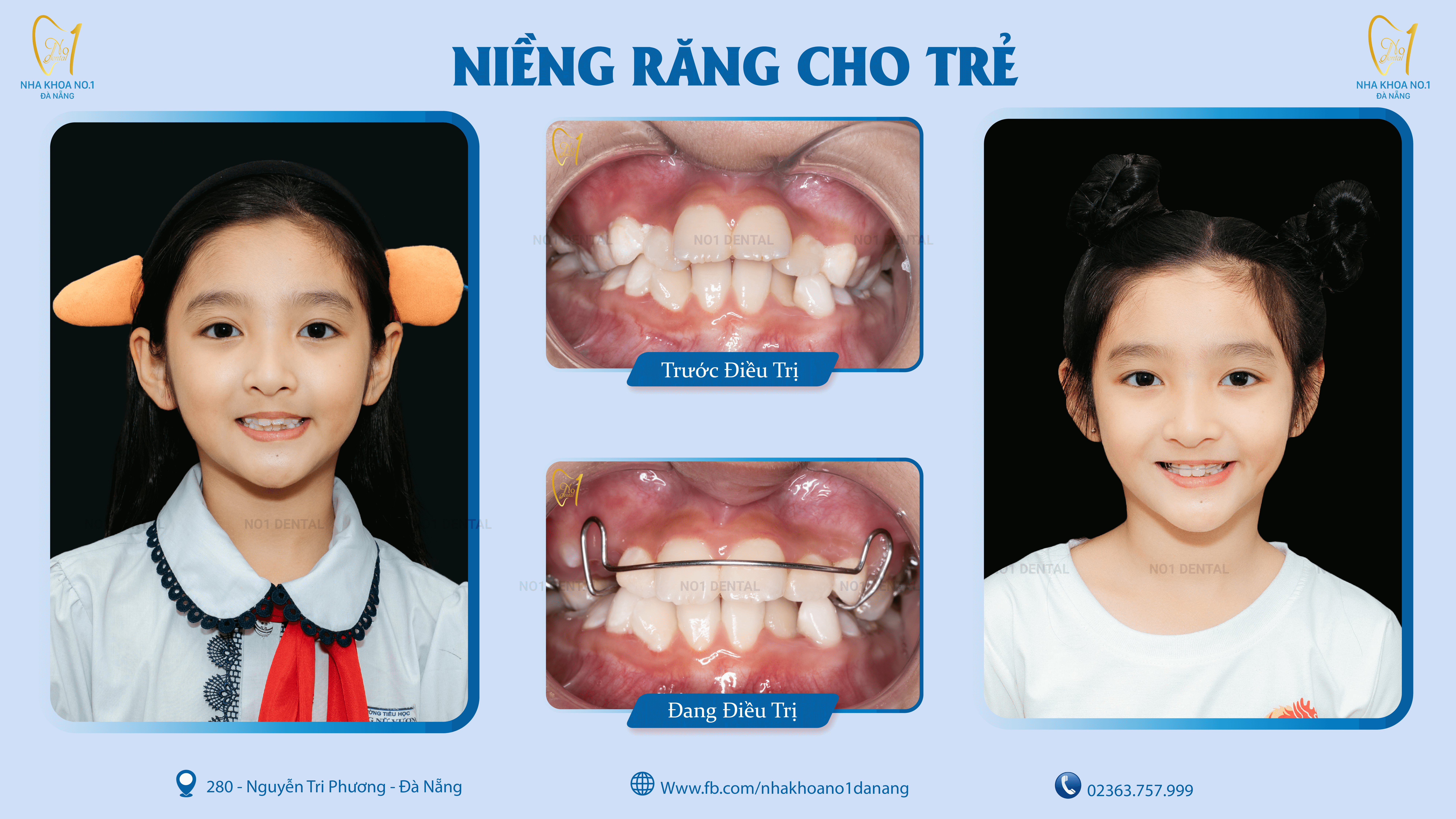 Thời điểm vàng niềng răng ở trẻ em