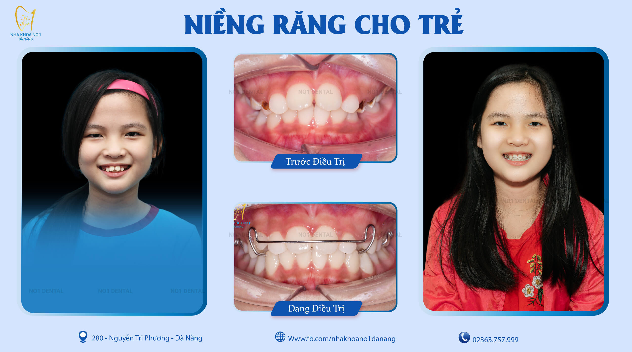 Thời điểm vàng niềng răng ở trẻ em