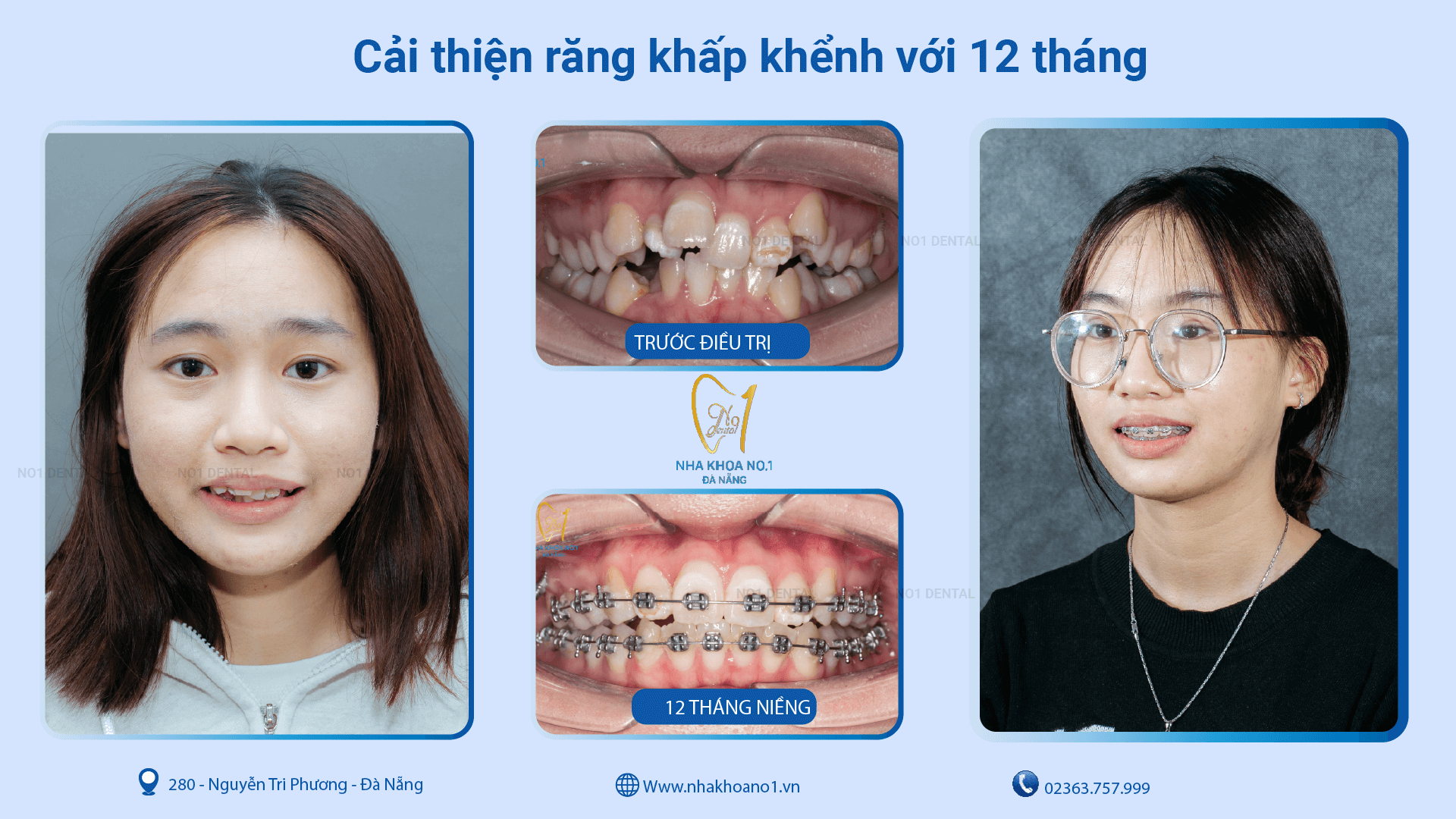 Cải thiện khấp khểnh khi niềng răng tại nha khoa No1 Đà Nẵng