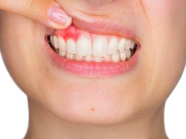 BỊ VIÊM NHA CHU CÓ BỌC RĂNG SỨ ĐƯỢC KHÔNG?