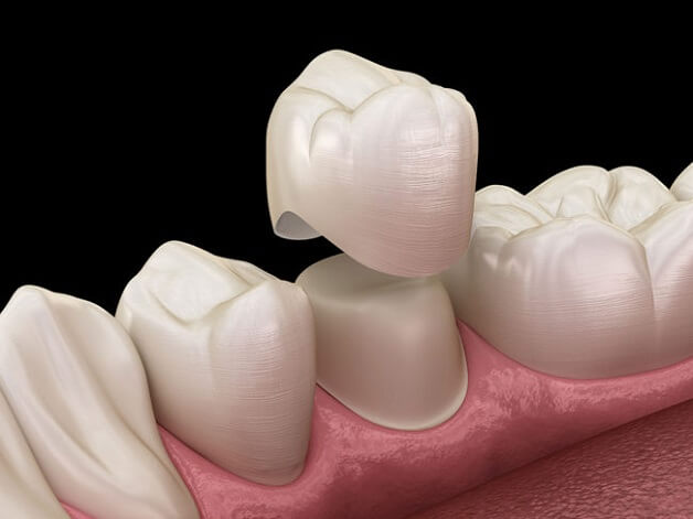 Bọc răng sứ giúp khắc phục răng hô, móm, xỉn màu,...