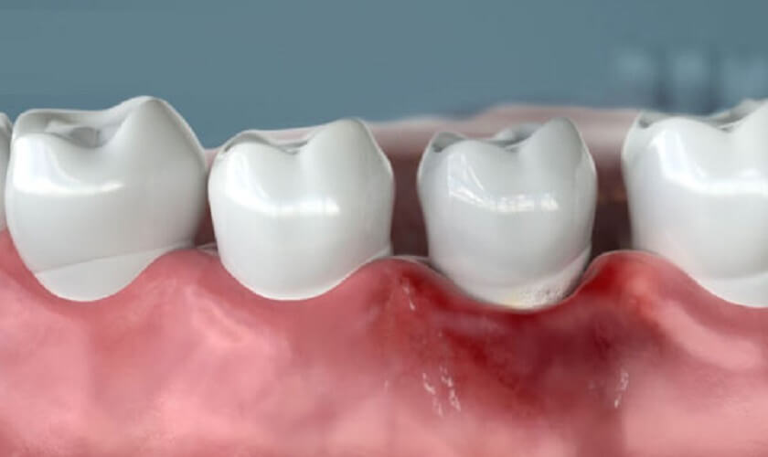 Biến chứng khi bọc răng sứ kém chất lượng