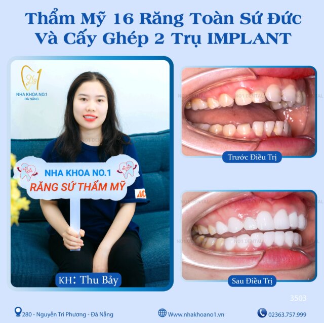 Nha khoa No1 Đà Nẵng tự hào là địa chỉ uy tín và tận tâm