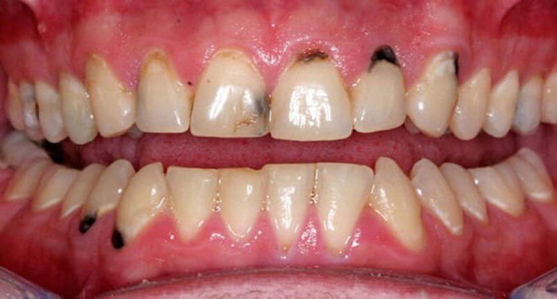 Chân răng bị đen do mảng bám tích tụ lâu dài