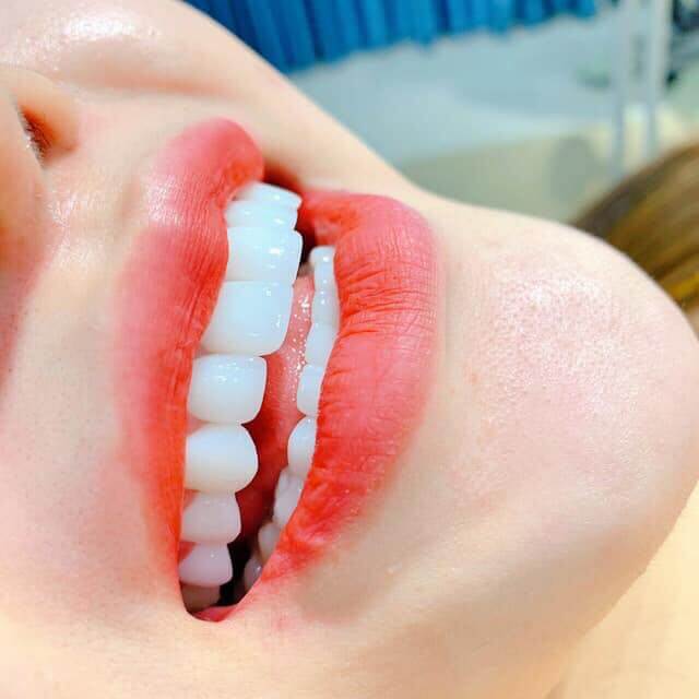 Dán sứ Veneer - phương pháp hiện đại giúp nâng cao thẩm mỹ cho nụ cười