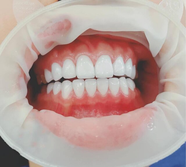 Nha khoa No1 Đà Nẵng - Chuyên dán sứ Veneer không mài răng