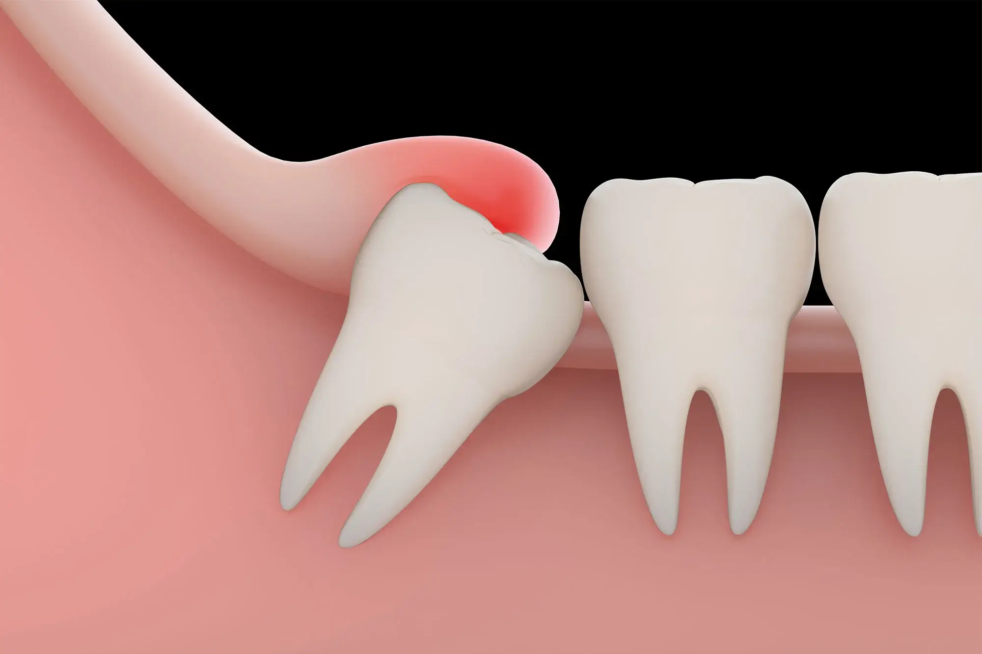 Hiểu rõ dấu hiệu mọc răng khôn sẽ giúp chủ động theo dõi và có biện pháp xử lý phù hợp