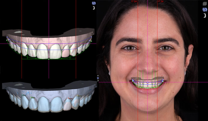 Công nghệ Digital Smile Design tiên tiến được áp dụng vào quy trình niềng răng thẩm mỹ