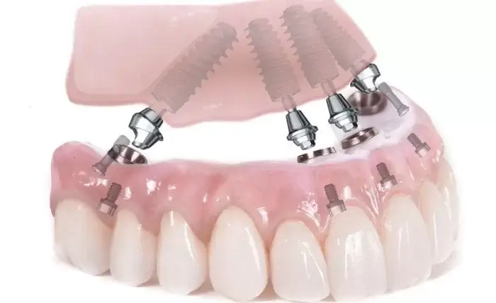 Implant All On 4 giúp ngăn ngừa tiêu xương răng
