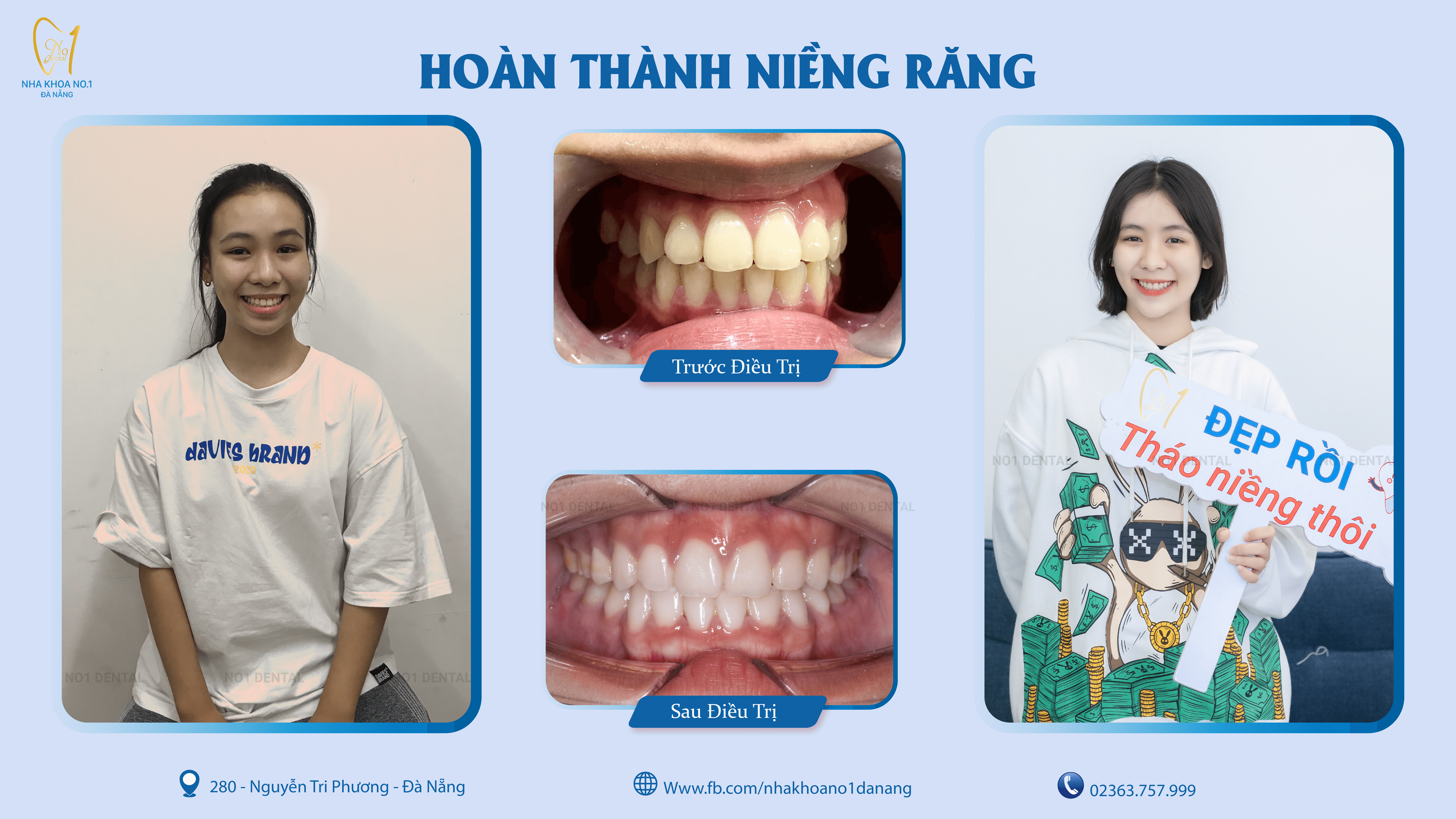 Nha khoa niềng răng uy tín Đà Nẵng
