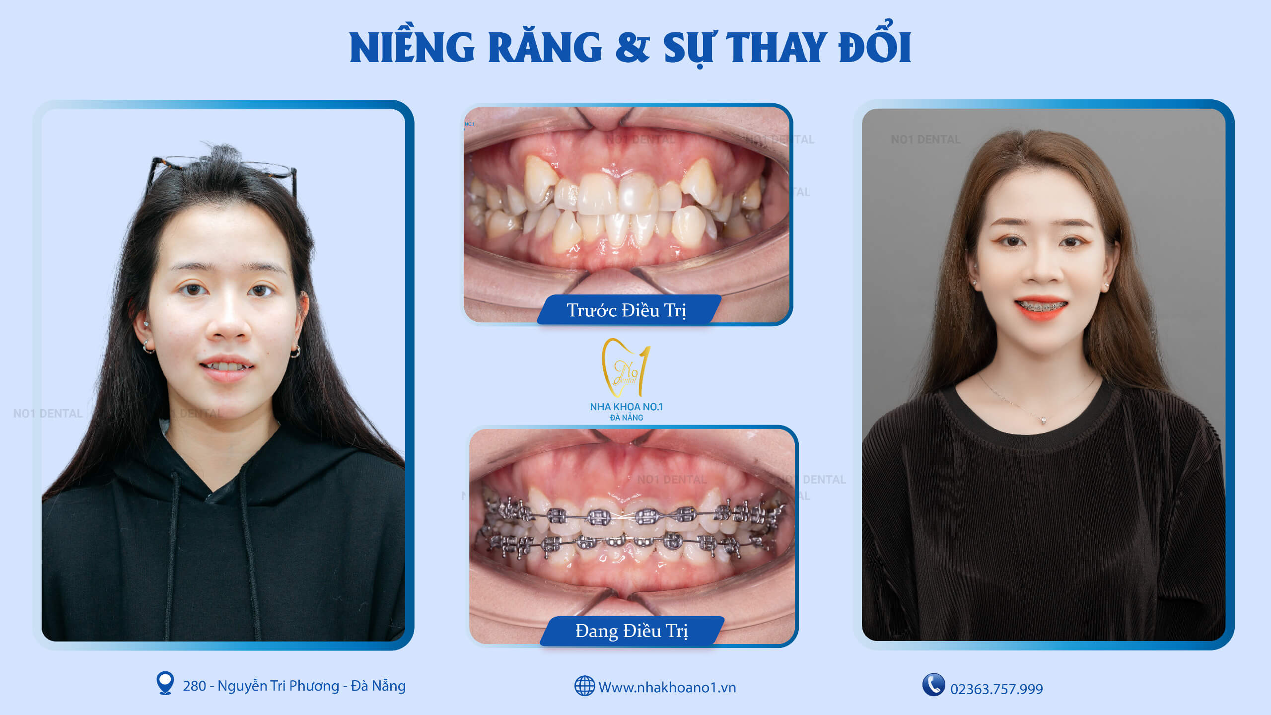 Niềng răng trả góp Đà Nẵng