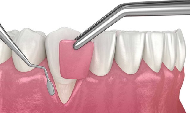 Cấy ghép lợi điều trị răng nhạy cảm, ê buốt