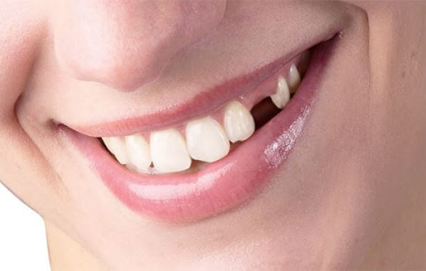 Các dạng tiêu xương chân răng thường gặp