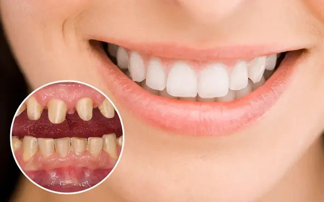 Quy trình làm răng sứ lần 2