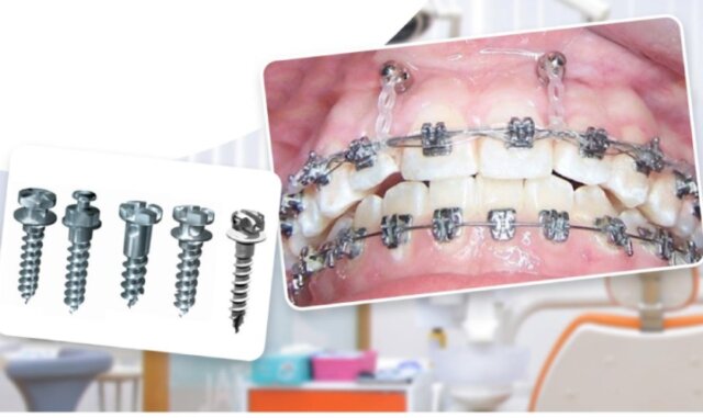 Bắt vít niềng răng