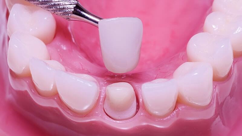 Dấu hiệu thông thường sau khi thực hiện bọc răng sứ