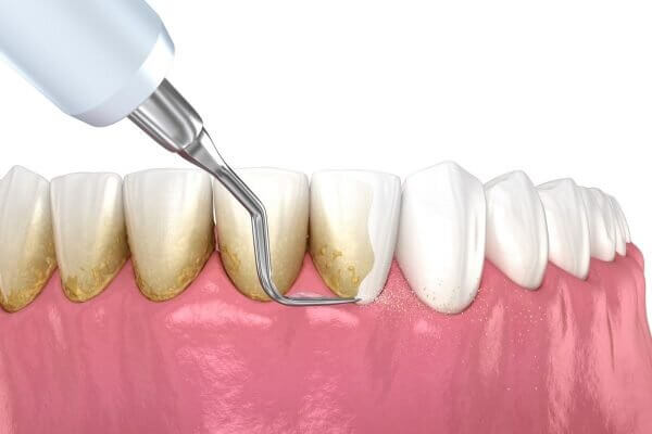 Mức độ nguy hiểm của cao răng cấp độ 3