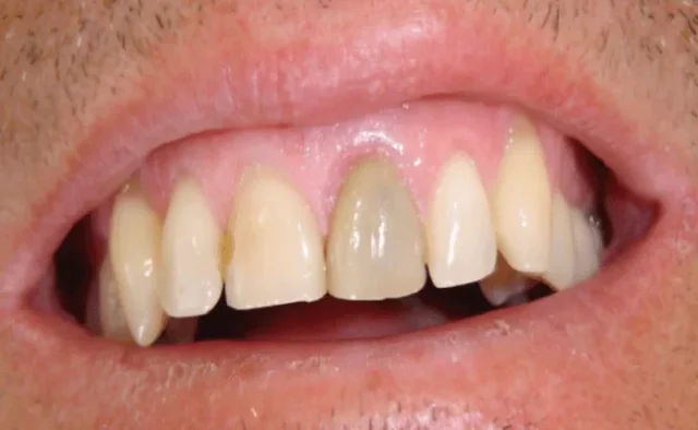 Giải pháp chữa tủy răng cửa