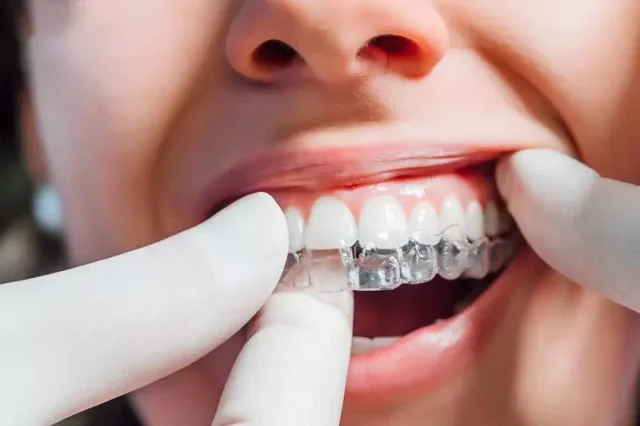 Đeo hàm duy trì vẫn bị chạy răng