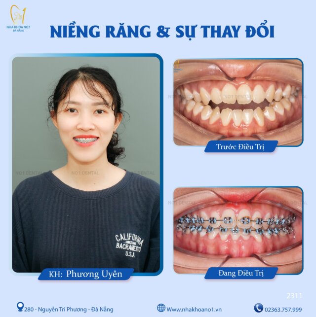 Niềng răng cần kiên trì để đạt kết quả mỹ mãn