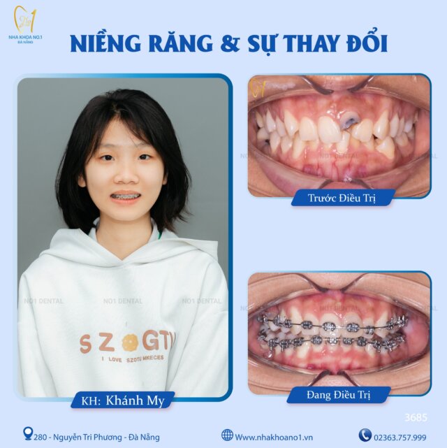 Dịch vụ niềng răng thẩm mỹ chất lượng tại Nha khoa No1 Đà Nẵng