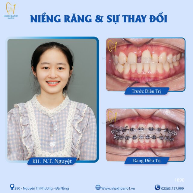 Địa chỉ uy tín để niềng răng - Nha khoa No1 Đà Nẵng
