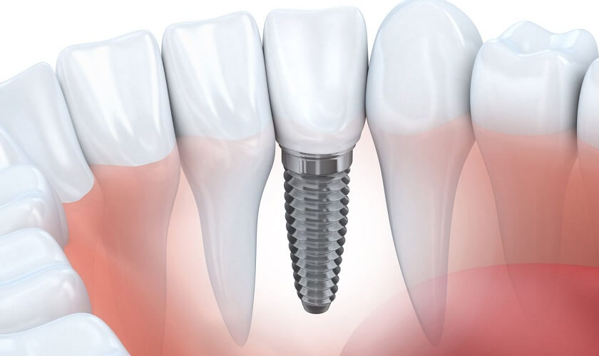 implant-nha-khoa-4