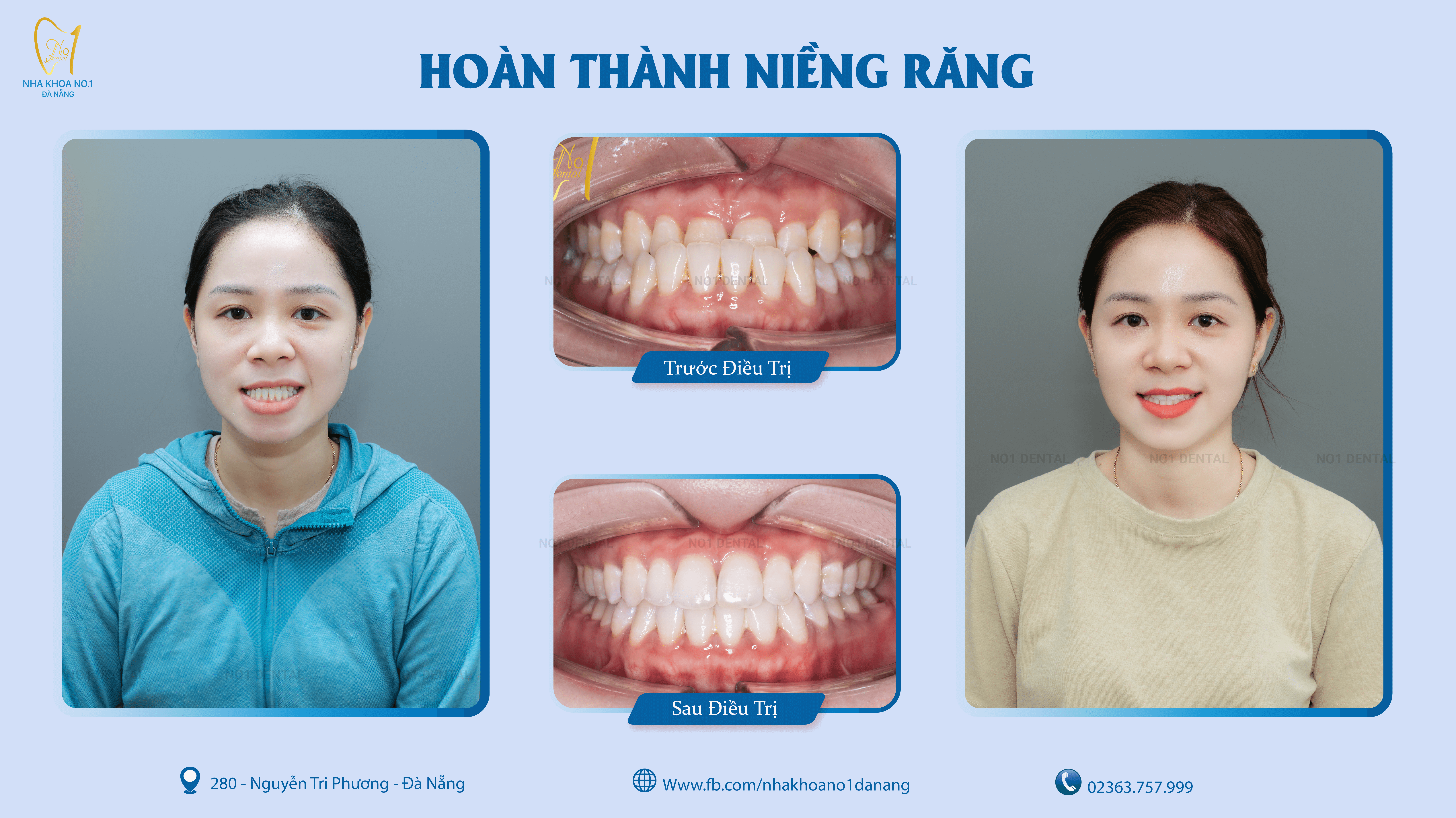 khop-can-chuan-3
