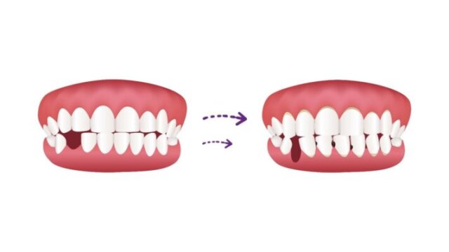 Điều trị mất răng sớm nhằm tránh ảnh hưởng đến sức khoẻ