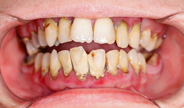 Các dấu hiệu bị mắc bệnh răng miệng phổ biến nhất