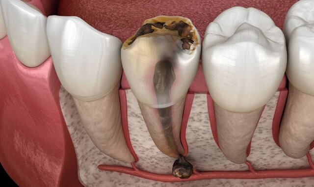 Viêm Tủy Răng là một trong các bệnh răng miệng thường gặp