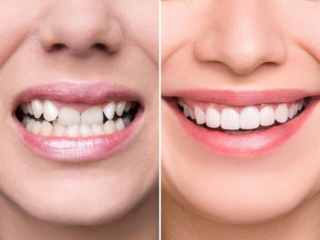 Những ai có thể bọc răng sứ?