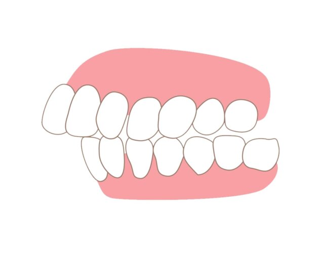 Các dạng răng bị hô thường gặp