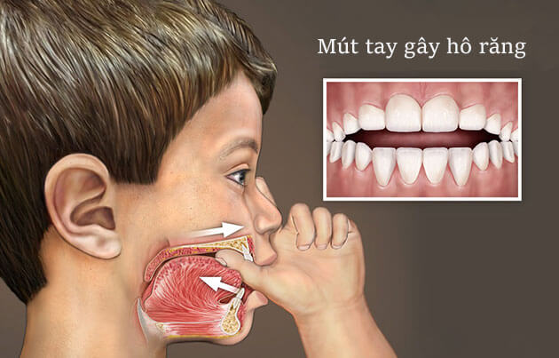 Mút ngón tay có thể làm lệch lạc răng
