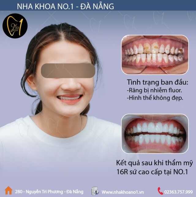Khắc phục thành công răng nhiễm Flour tại Nha khoa No1 Đà Nẵng