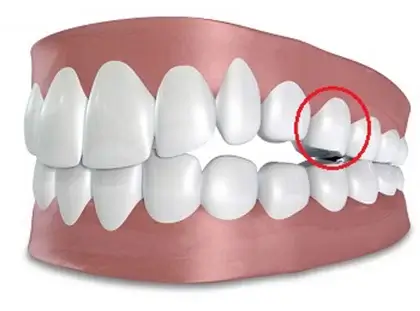 Nhổ răng số 5 để niềng có đau không?