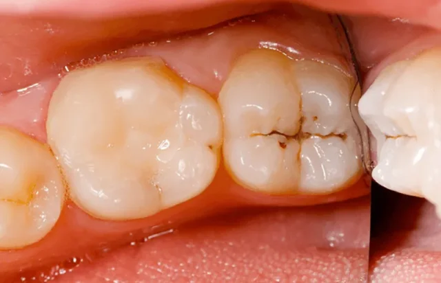 Răng bị sâu có trám được không? – Những yếu tố quyết định